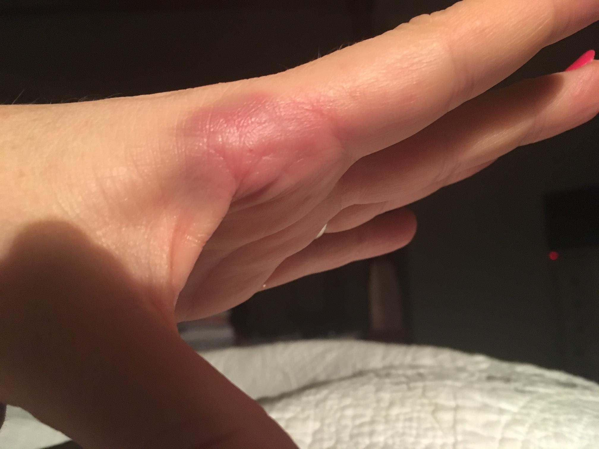 how to make a cushion injury